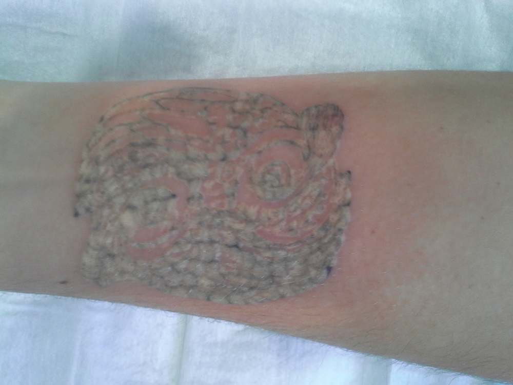 Central Coast Tattoo Removal Skin Treatments Beauty Treatments 