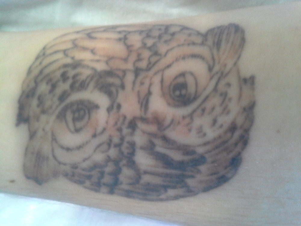 Central Coast Tattoo Removal Skin Treatments Beauty Treatments
