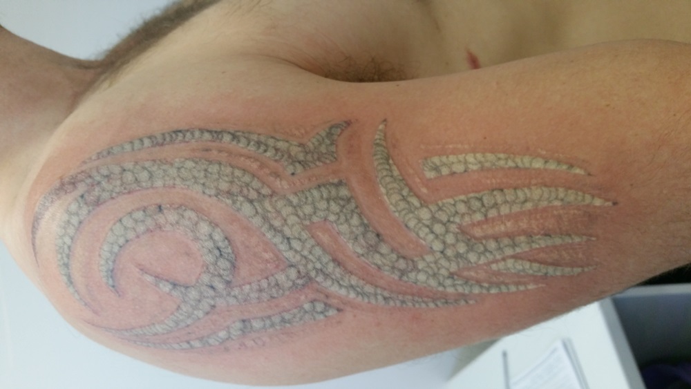 Central Coast Tattoo Removal Skin Treatments Beauty Treatments 