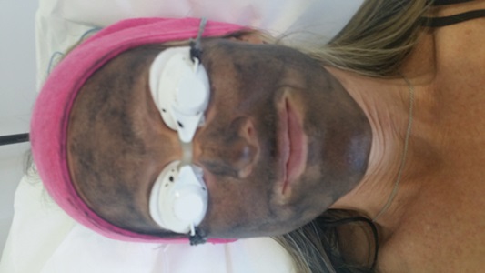 Central Coast Laser Beauty Treatments Tattoo Removal Skin Treatments