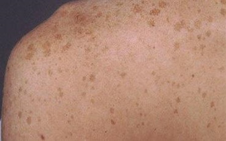 Central Coast Laser Skin Treatments Tattoo Removal